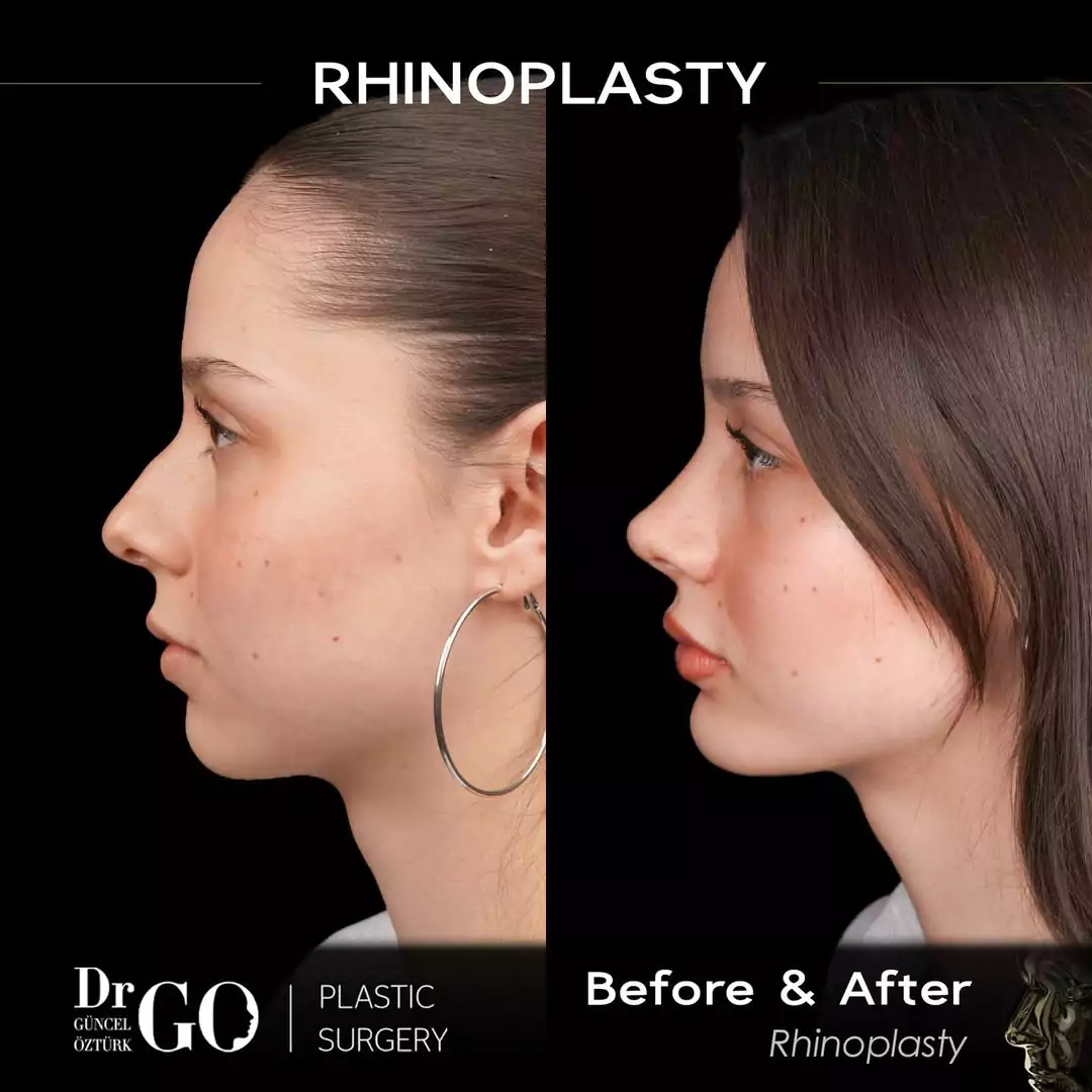 Female rhinoplasty before-and-after side profile published by Güncel Öztürk, image 1