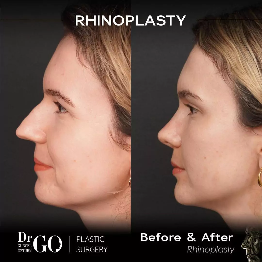 Female rhinoplasty before-and-after side profile published by Güncel Öztürk, image 2