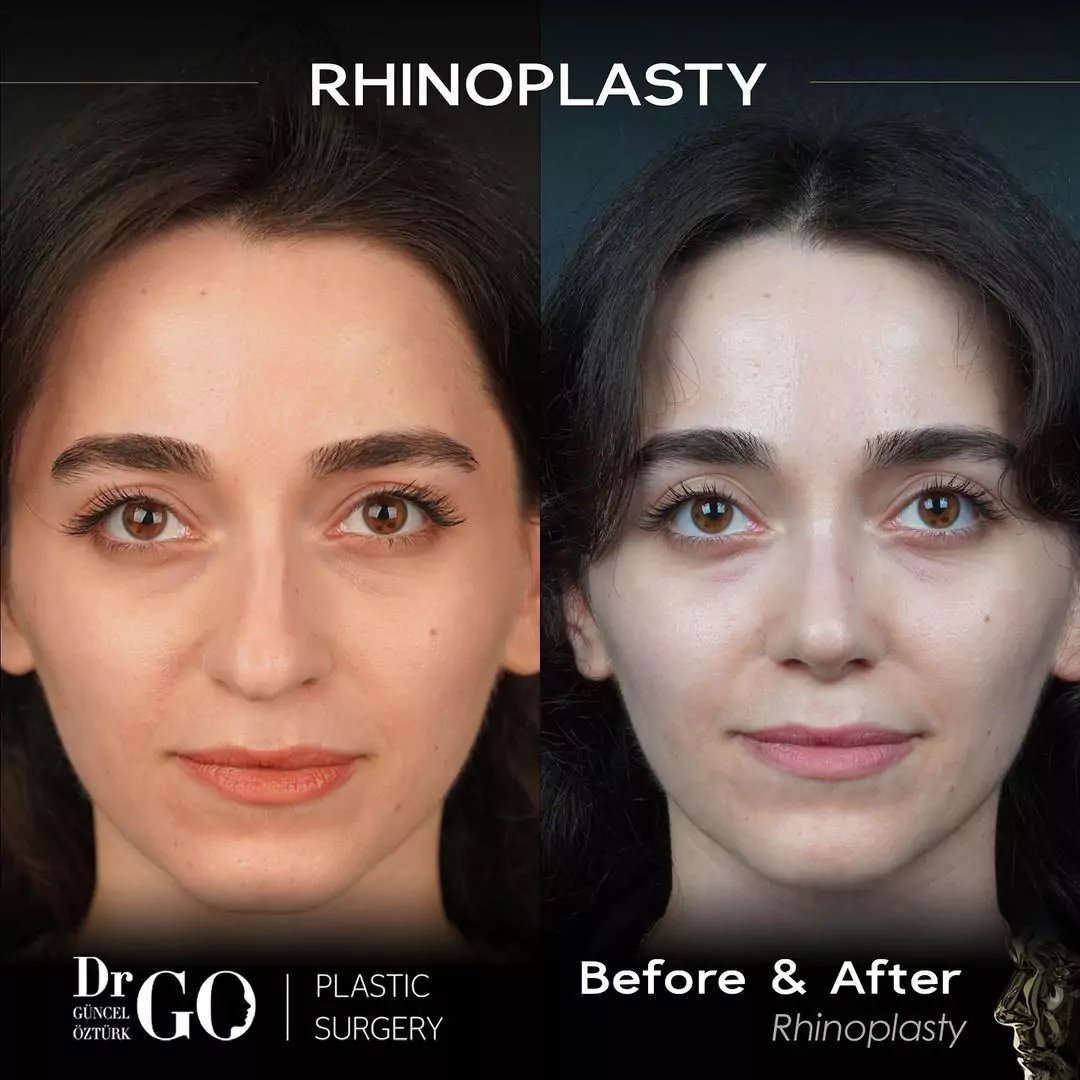 Female rhinoplasty before-and-after frontal view published by Güncel Öztürk, image 3