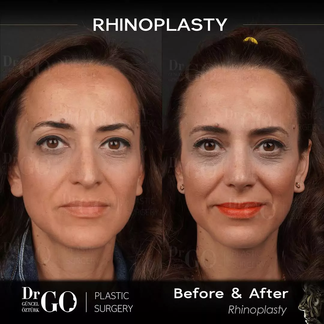 Female rhinoplasty before-and-after frontal view published by Güncel Öztürk, image 4