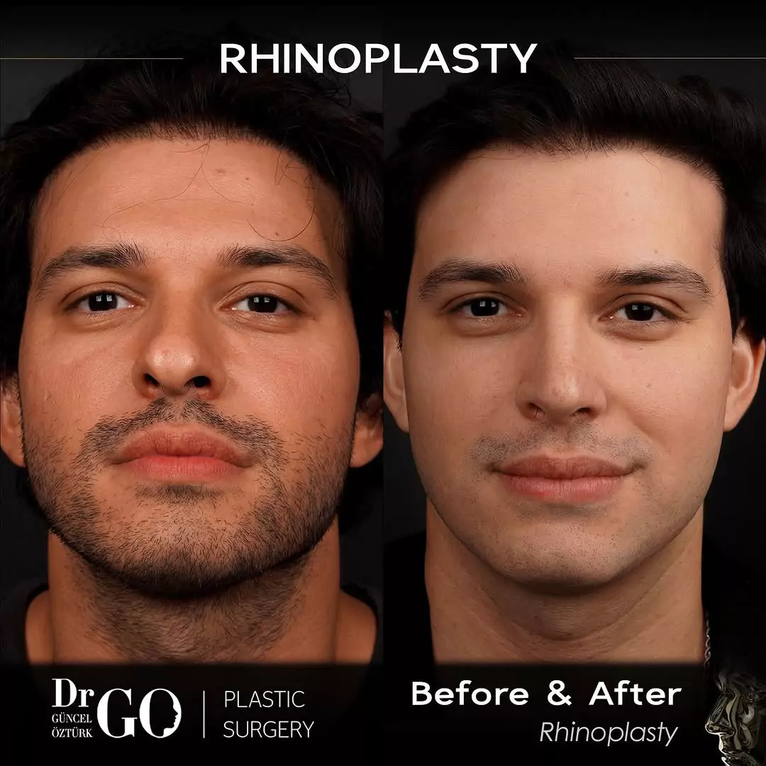 Male rhinoplasty before-and-after frontal view published by Güncel Öztürk, image 5