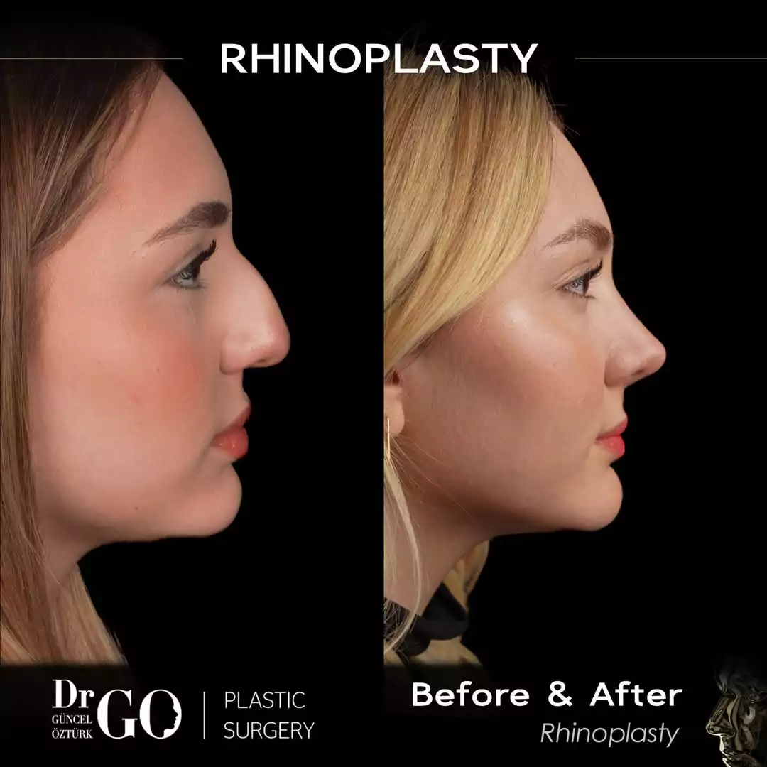 Female rhinoplasty before-and-after side profile published by Güncel Öztürk, image 6
