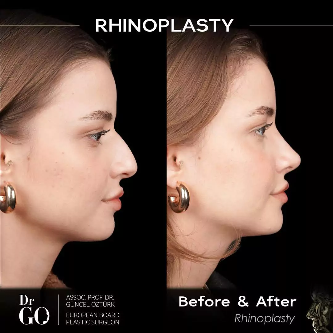 Female rhinoplasty before-and-after side profile published by Güncel Öztürk, image 7