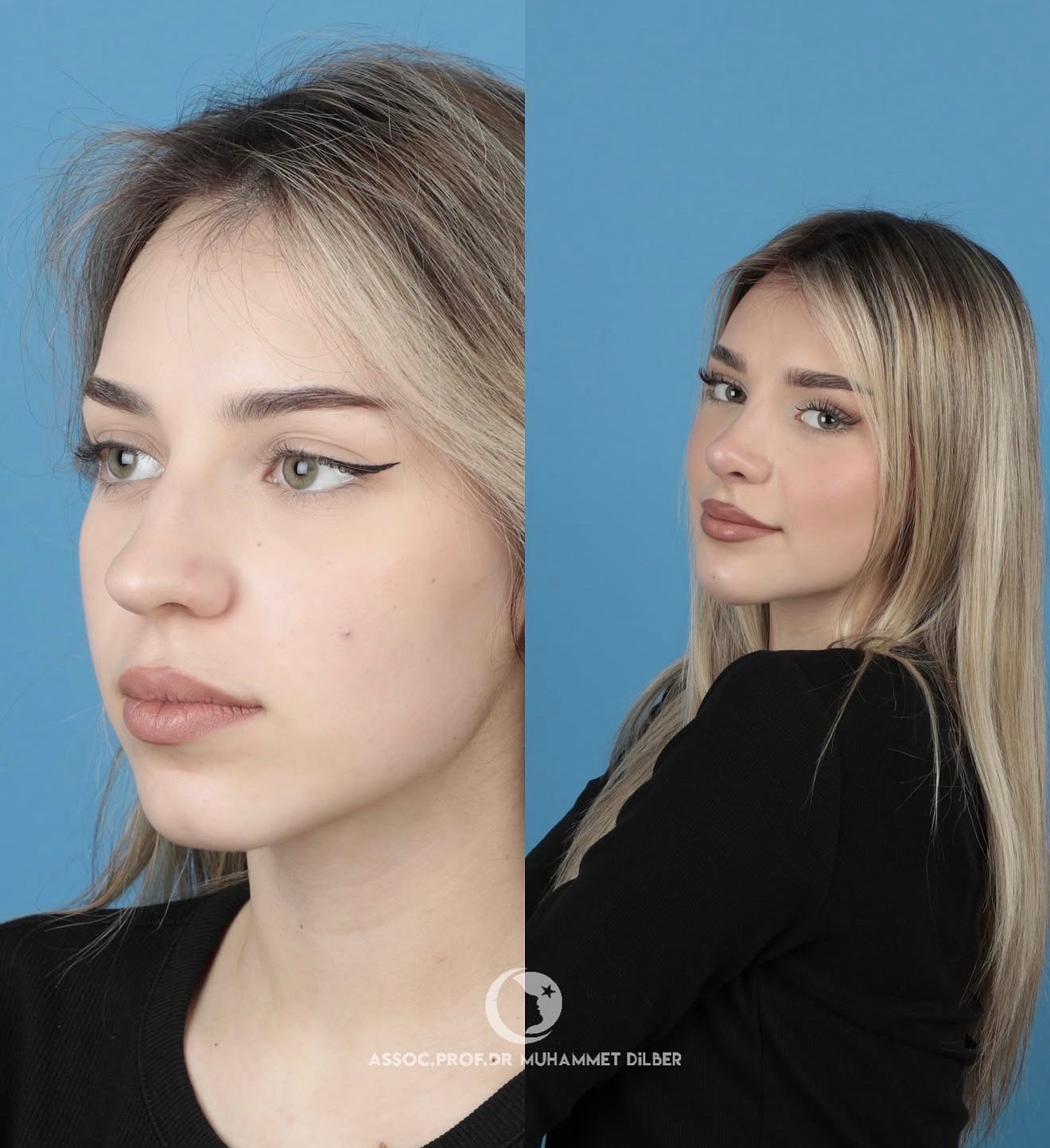 Official rhinoplasty before and after photograph published by Dr Muhammet Dilber in Istanbul, image 1