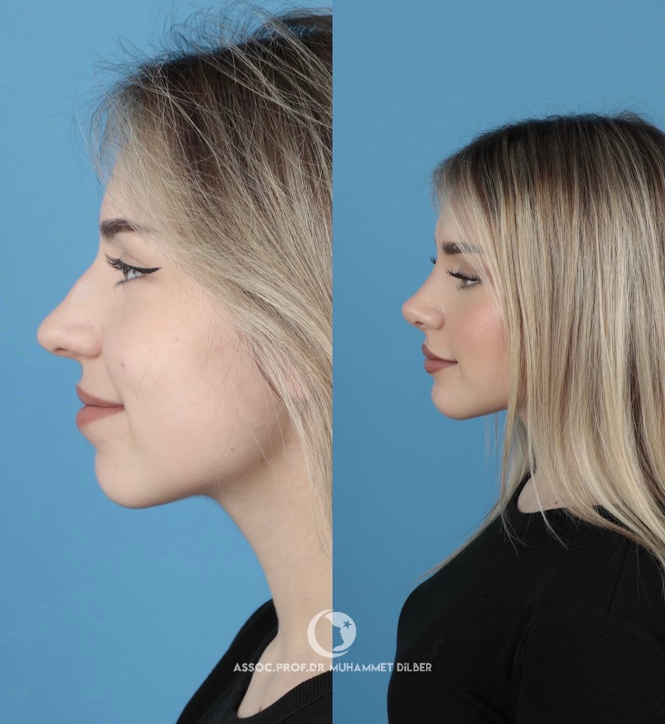 Official rhinoplasty before and after photograph published by Dr Muhammet Dilber in Istanbul, image 2