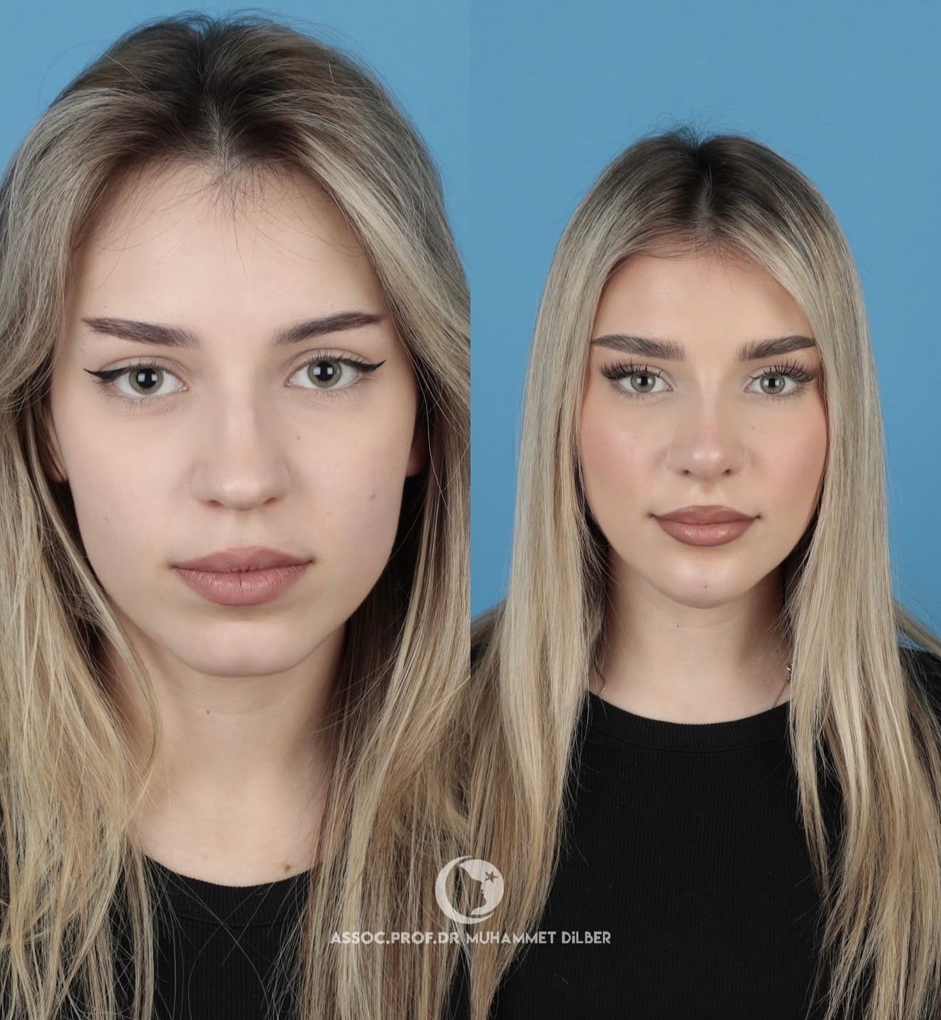 Official rhinoplasty before and after photograph published by Dr Muhammet Dilber in Istanbul, image 3