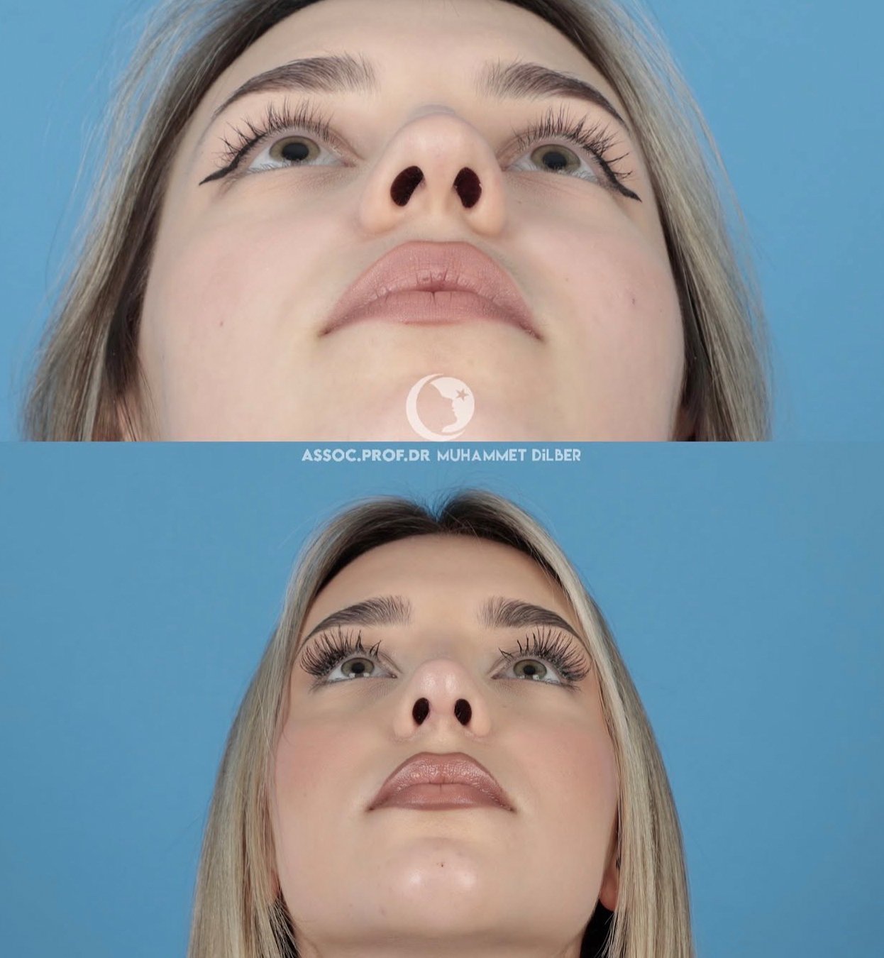 Official rhinoplasty before and after photograph published by Dr Muhammet Dilber in Istanbul, image 4