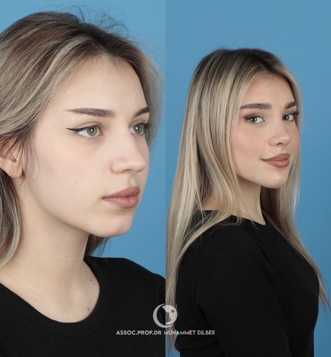 Official rhinoplasty before and after photograph published by Dr Muhammet Dilber in Istanbul, image 5