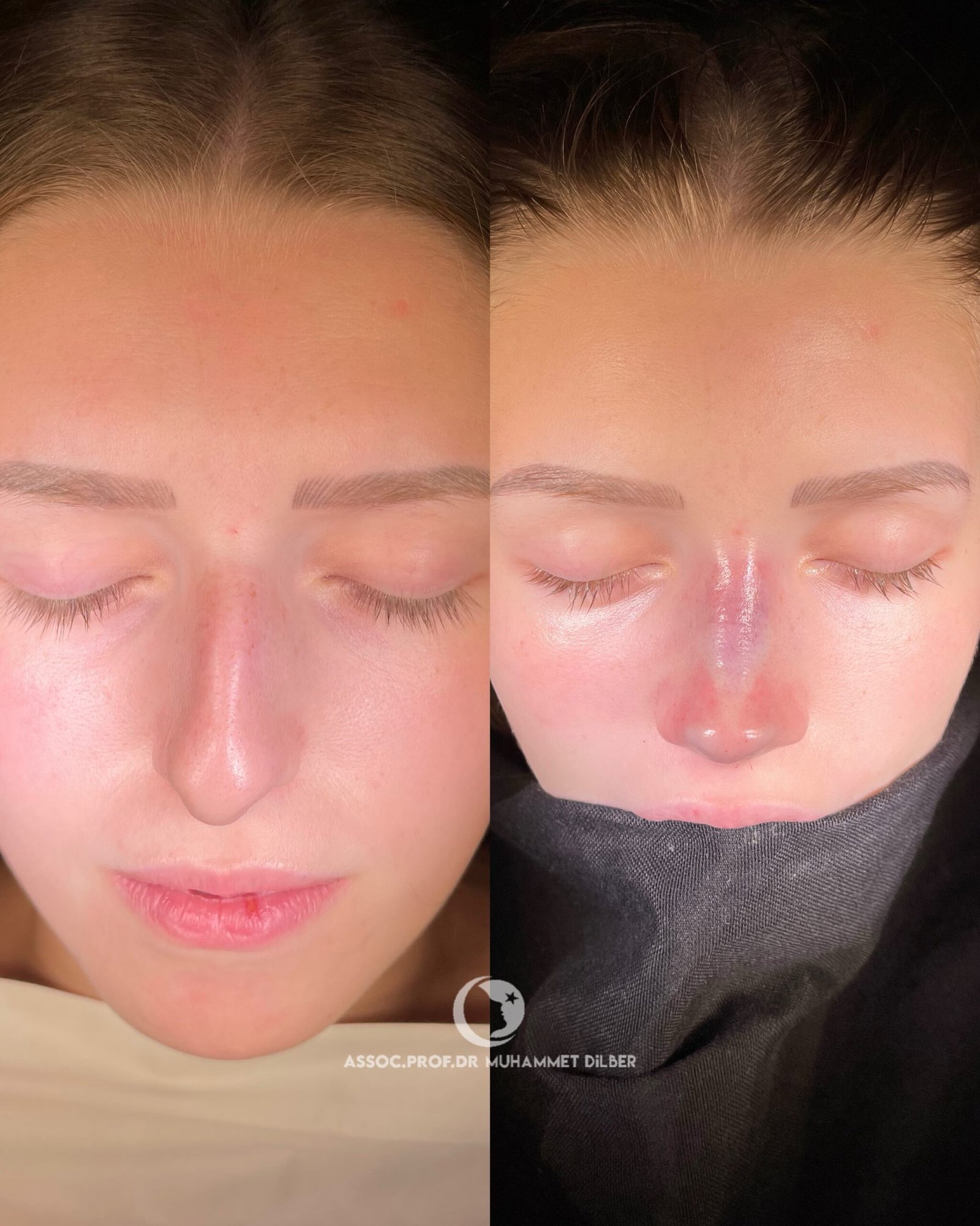 Official rhinoplasty before and after photograph published by Dr Muhammet Dilber in Istanbul, image 6