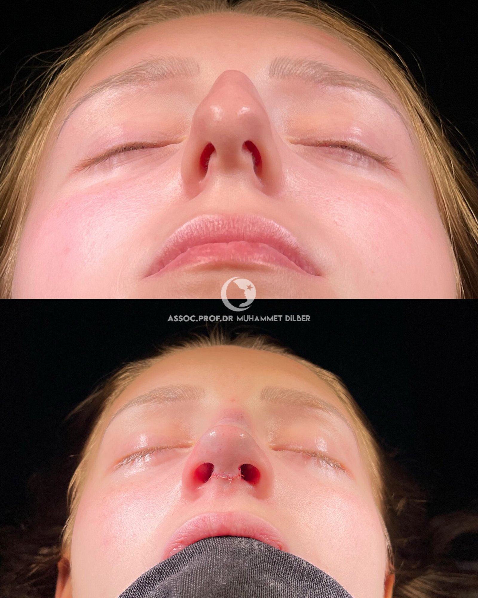 Official rhinoplasty before and after photograph published by Dr Muhammet Dilber in Istanbul, image 7