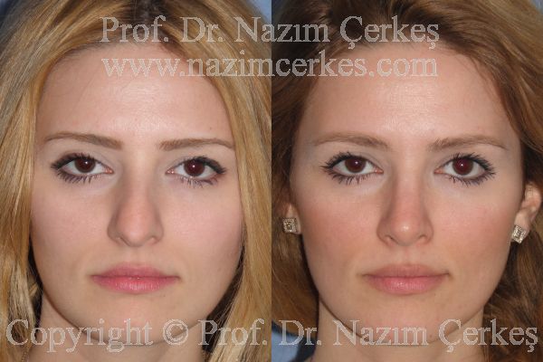 Female rhinoplasty before-and-after frontal view from Nazım Çerkeş’s official gallery, image 1
