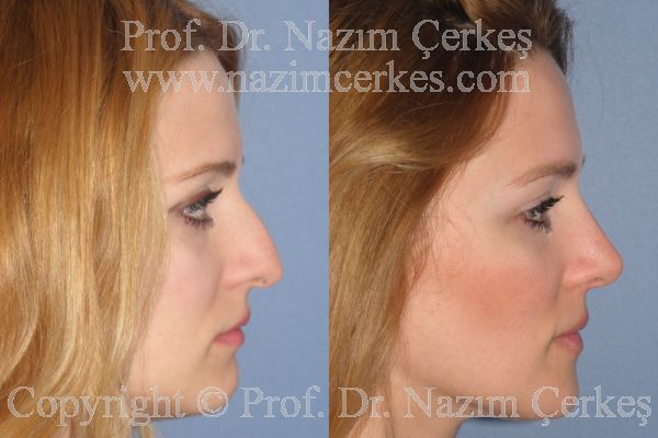 Female rhinoplasty before-and-after profile from Nazım Çerkeş’s official gallery, image 2