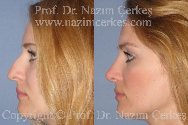 Female rhinoplasty before-and-after opposite profile from Nazım Çerkeş’s official gallery, image 3