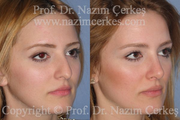Female rhinoplasty before-and-after angled view from Nazım Çerkeş’s official gallery, image 4