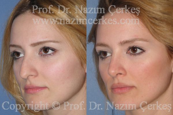 Female rhinoplasty before-and-after second angled view from Nazım Çerkeş’s official gallery, image 5