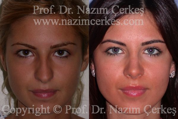 Female rhinoplasty before-and-after frontal view from Nazım Çerkeş’s official gallery, image 6