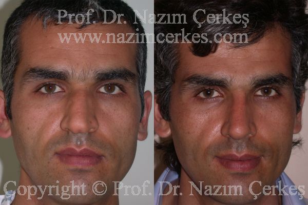 Male rhinoplasty before-and-after frontal view from Nazım Çerkeş’s official gallery