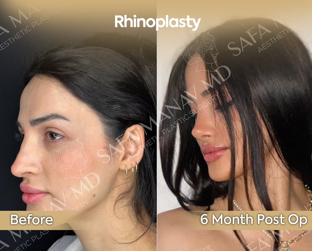 Provider-published before-and-after comparison, Safa Manav, image 1