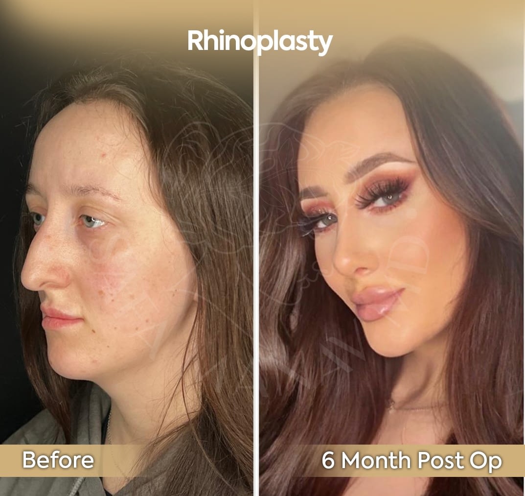 Provider-published before-and-after comparison, Safa Manav, image 2