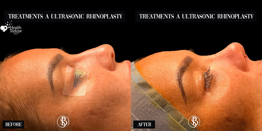 Provider-published before-and-after comparison, Salih Onur Basat, image 1