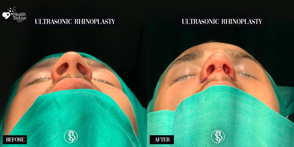 Provider-published before-and-after comparison, Salih Onur Basat, image 2