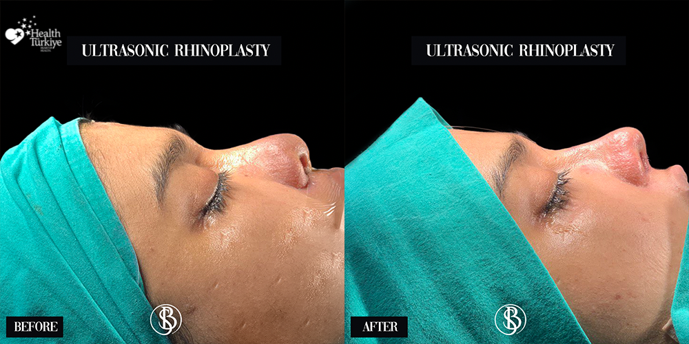 Provider-published before-and-after comparison, Salih Onur Basat, image 3
