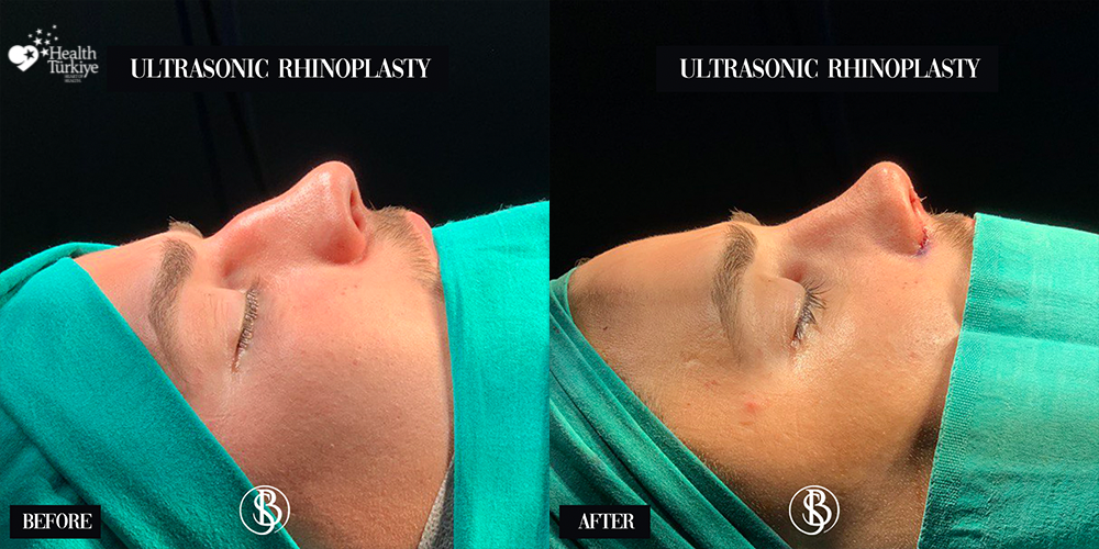 Provider-published before-and-after comparison, Salih Onur Basat, image 4