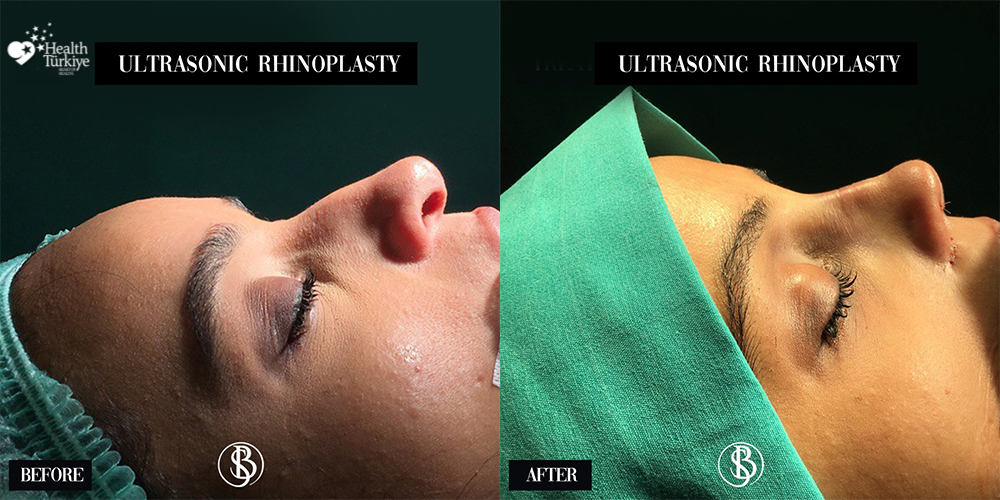 Provider-published before-and-after comparison, Salih Onur Basat, image 5