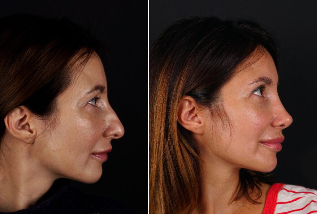 Side-profile rhinoplasty before-and-after comparison published by Seçkin Ulusoy, image 1