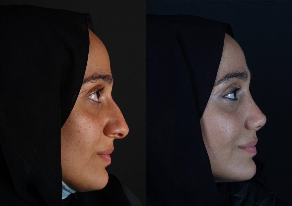 Side-profile rhinoplasty before-and-after comparison published by Seçkin Ulusoy, image 2
