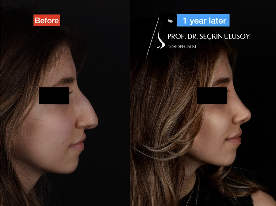 One-year rhinoplasty before-and-after side-profile comparison published by Seçkin Ulusoy