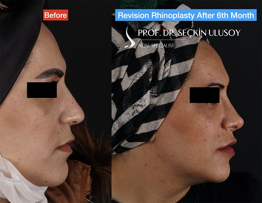 Revision rhinoplasty before-and-after side-profile comparison published by Seçkin Ulusoy