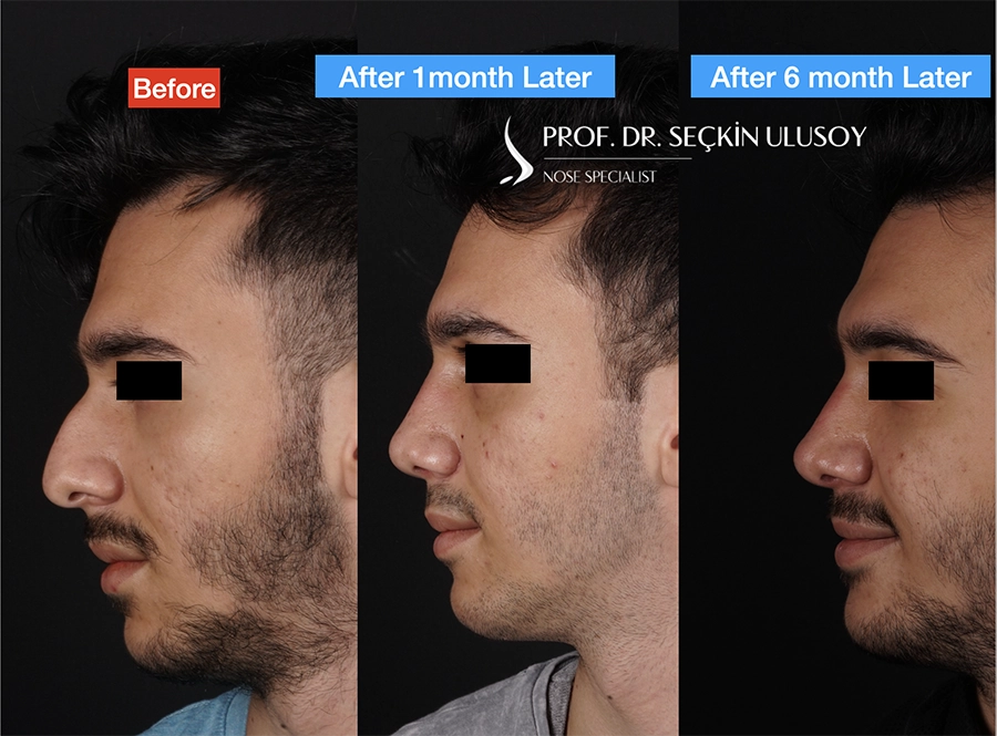 Male rhinoplasty before-and-after side-profile comparison published by Seçkin Ulusoy