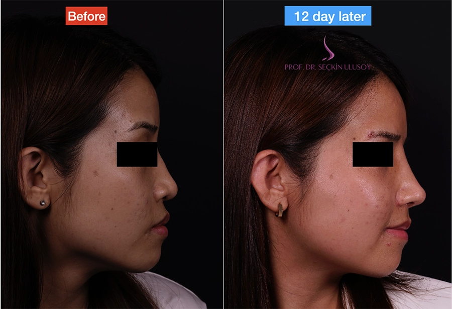 Early rhinoplasty before-and-after side-profile comparison published by Seçkin Ulusoy