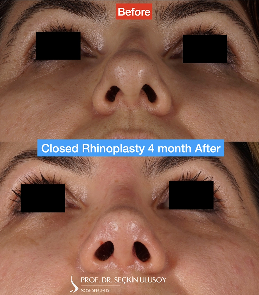 Underside nasal-view rhinoplasty before-and-after comparison published by Seçkin Ulusoy