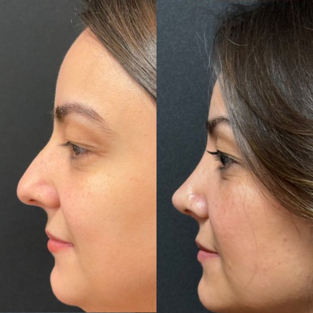 Provider-published before-and-after comparison, Sinan Eroğlu, image 1