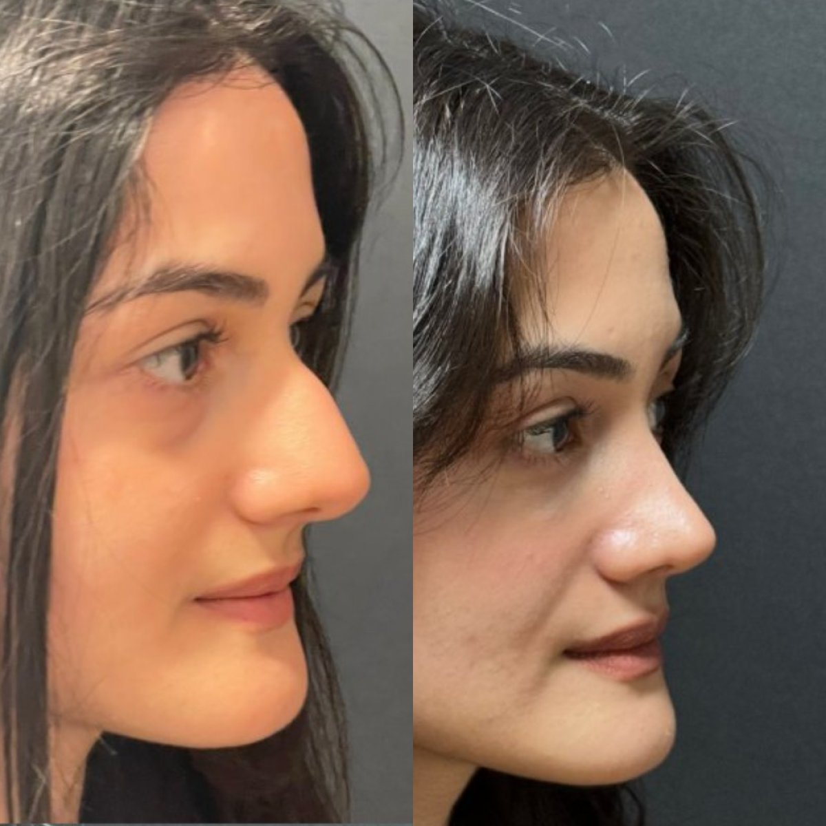 Provider-published before-and-after comparison, Sinan Eroğlu, image 2