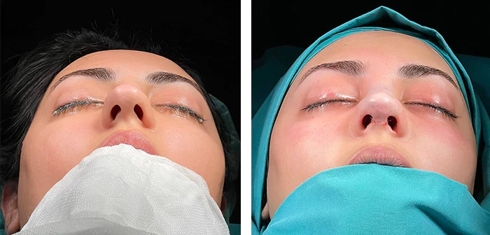 Facial-surgery before/after; procedure not independently confirmed, Sinan Eroğlu, image 4