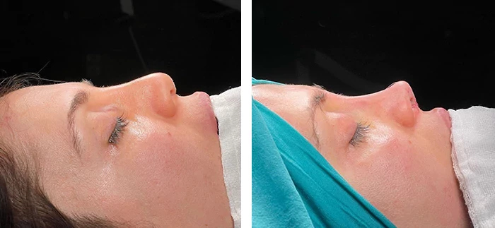 Provider-published before-and-after comparison, Sinan Eroğlu, image 5