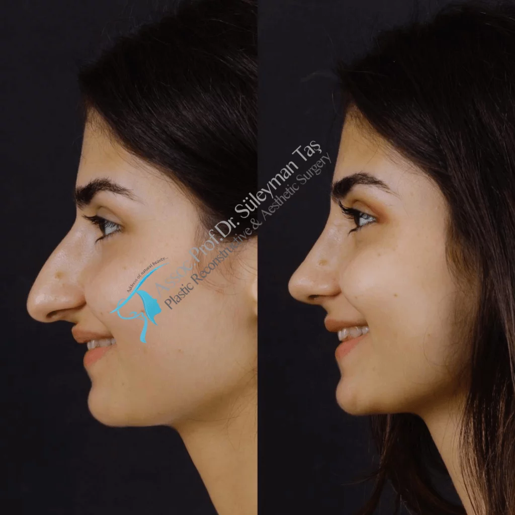 Female revision rhinoplasty before-and-after profile published by Süleyman Taş, image 1