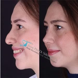 Female revision rhinoplasty before-and-after view published by Süleyman Taş, image 2
