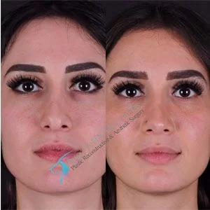 Female revision rhinoplasty before-and-after frontal view published by Süleyman Taş, image 3