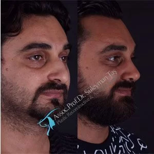 Male rhinoplasty before-and-after angled view published by Süleyman Taş, image 4