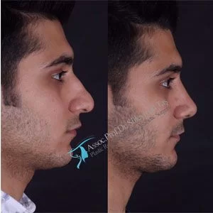 Male rhinoplasty before-and-after side profile published by Süleyman Taş, image 5