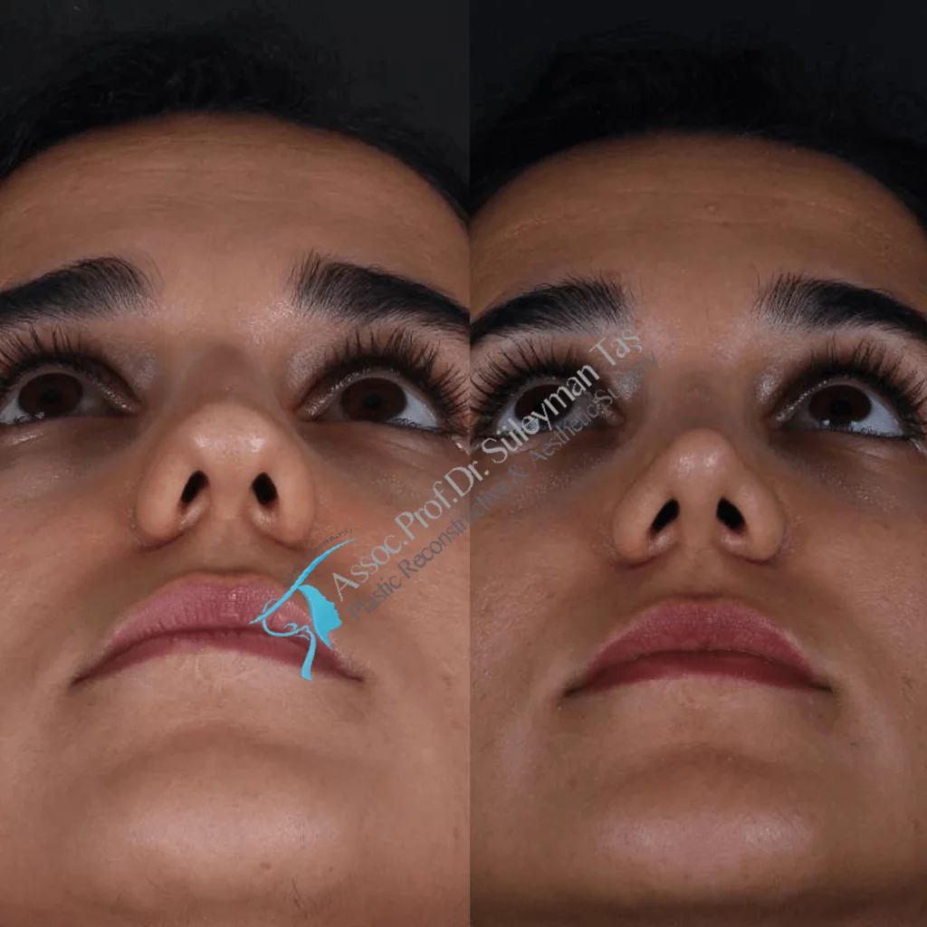 Female rhinoplasty before-and-after underside nasal view published by Süleyman Taş, image 6
