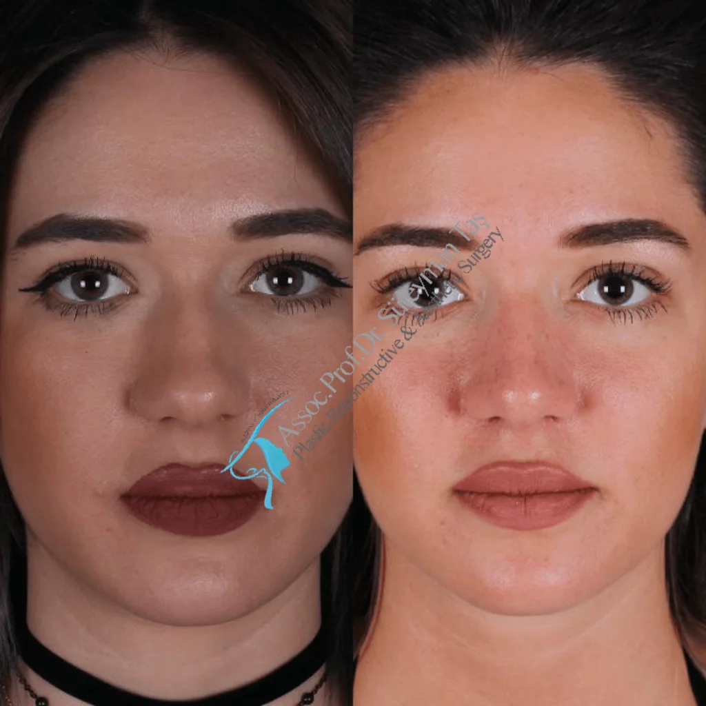 Female rhinoplasty before-and-after frontal view published by Süleyman Taş, image 7