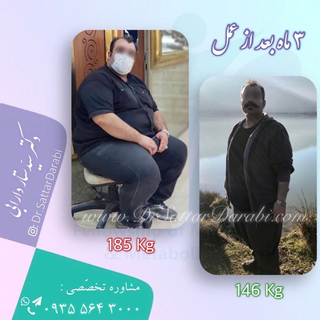 Weight loss surgery before and after case 1 published by Dr Sattar Darabi