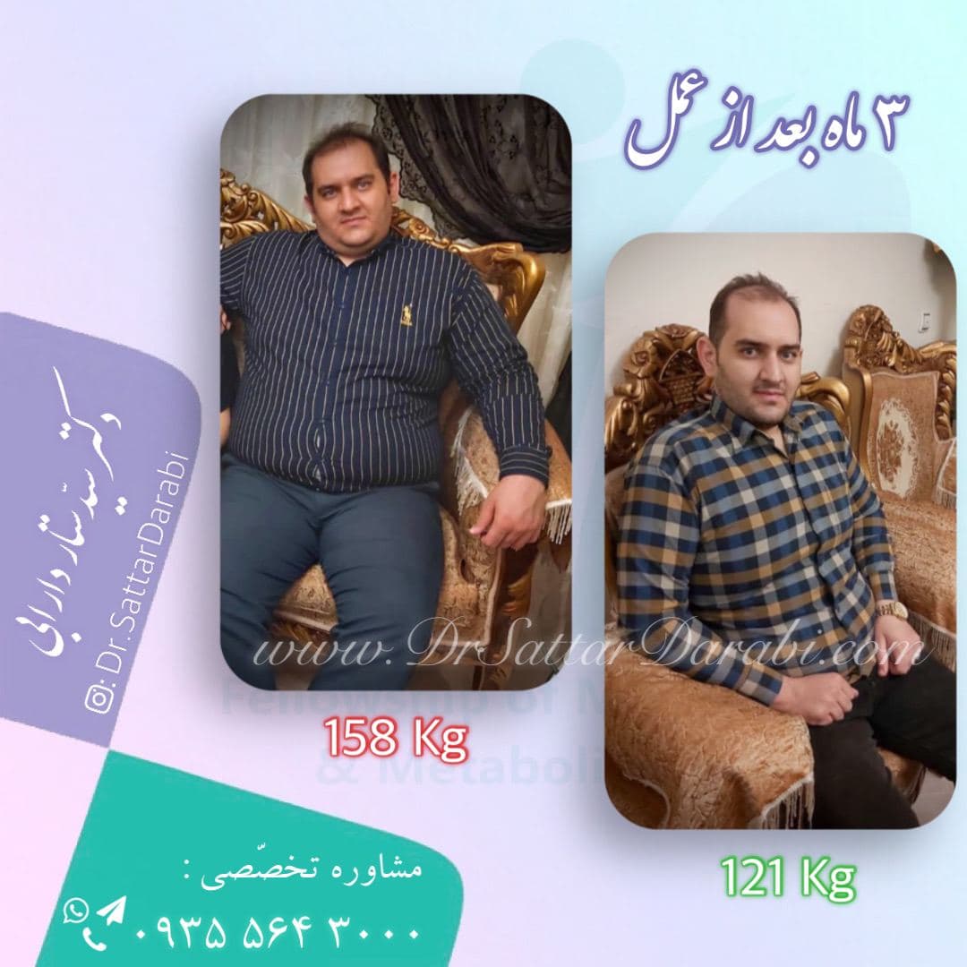 Weight loss surgery before and after case 3 published by Dr Sattar Darabi
