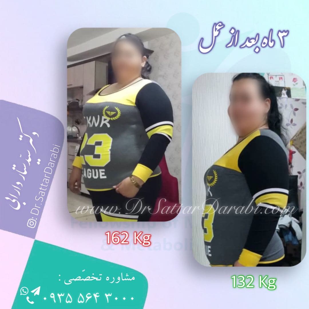 Weight loss surgery before and after case 4 published by Dr Sattar Darabi