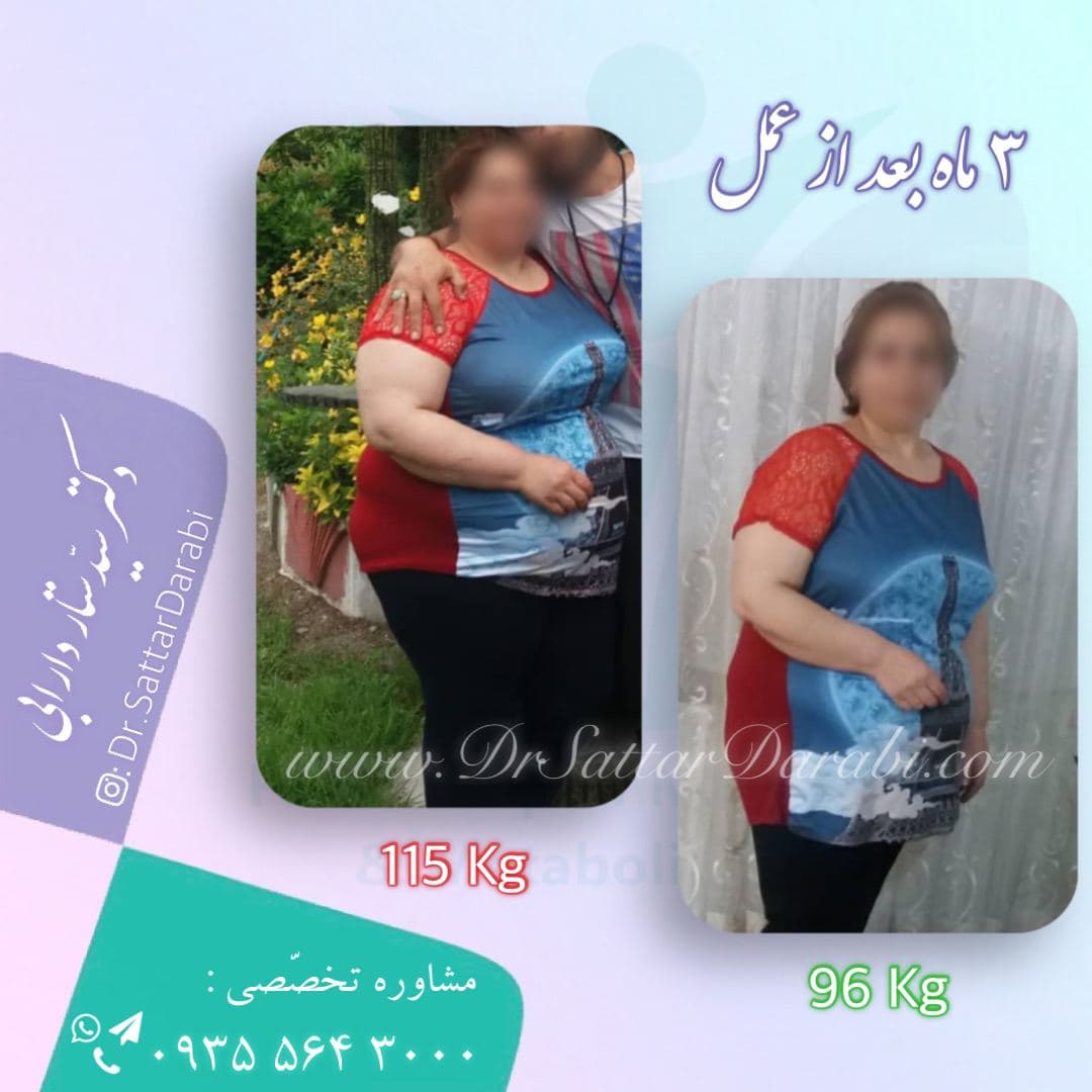 Weight loss surgery before and after case 5 published by Dr Sattar Darabi